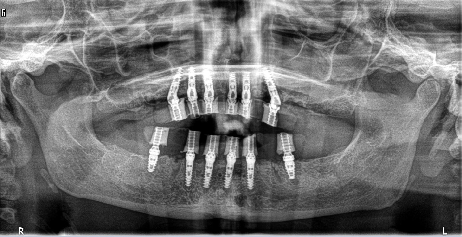 Adin’s CloseFit Conical implants Why conical connection implants are